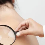 Científico argentino logra la primera vacuna contra el melanoma tras 30 años de investigación