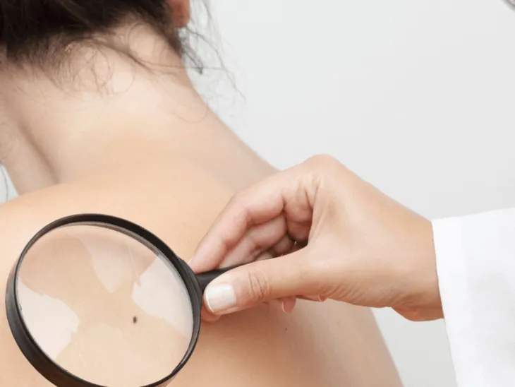 Científico argentino logra la primera vacuna contra el melanoma tras 30 años de investigación